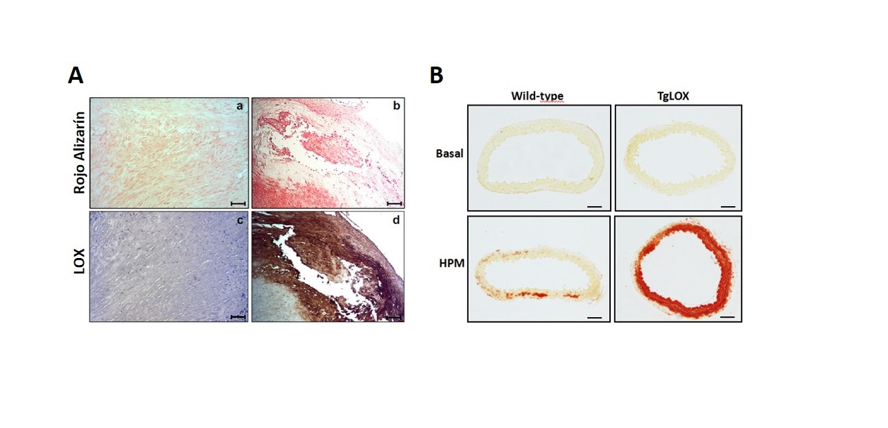 Identifican las enzimas lisil oxidasa y lisil hidroxilasa 1 como potenciales dianas terapéuticas contra la calcificación vascular