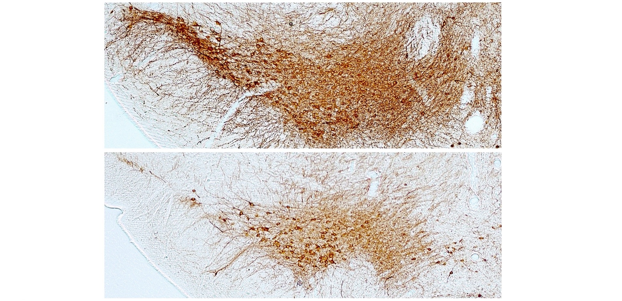 La diabetes constituye un factor de riesgo para desarrollar párkinson