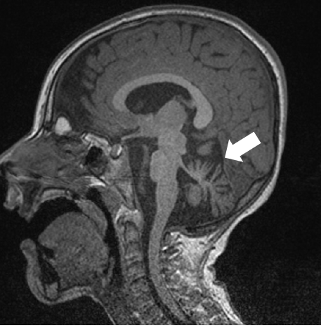 Identifican dos nuevos genes implicados en enfermedades del desarrollo del cerebro