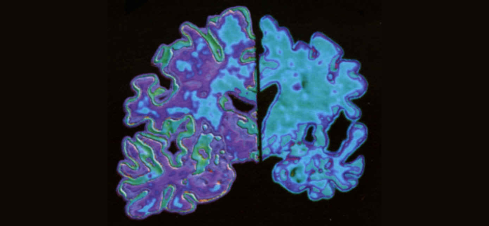 Cerebro sano a la izquierda y con Alzheimer a la derecha.