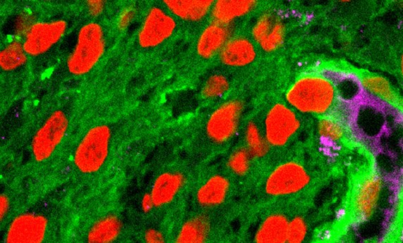 Nuevos biomarcadores para determinar daño neuronal en la enfermedad de Alzheimer