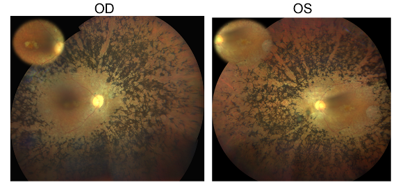 Identifican un nuevo gen candidato de retinosis pigmentaria con una estrategia de análisis del genoma completo