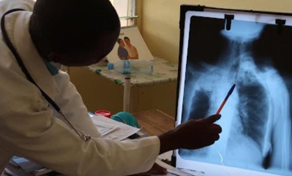 La tuberculosis resistente a fármacos podría estar infradiagnosticada, según un análisis genómico en el sur de Mozambique