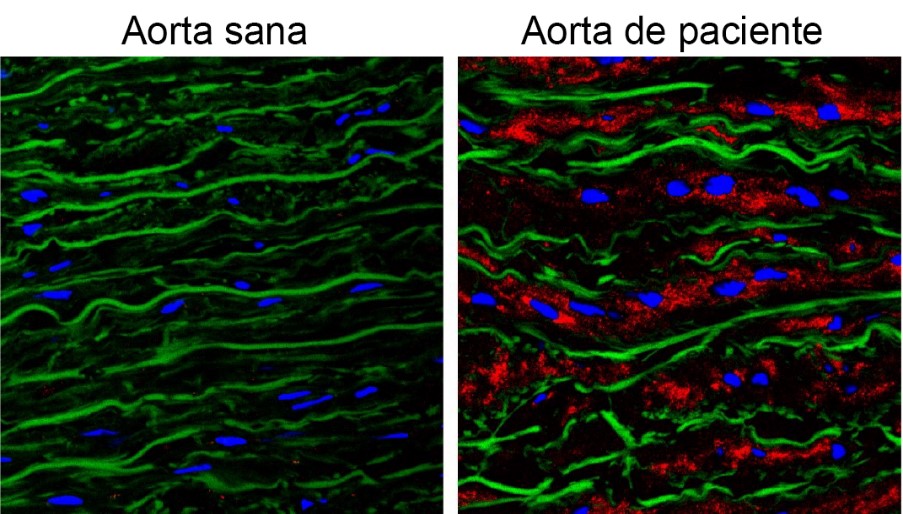 La acumulación de la proteína Versicano es responsable de los aneurismas de aorta del síndrome de Marfan
