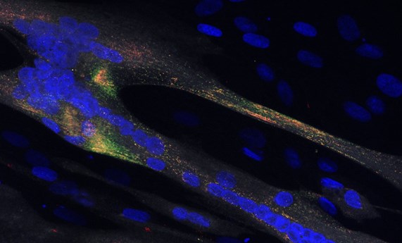 Descubren un nuevo gen causante de una miopatía congénita Descubren un nuevo gen causante de una miopatía congénita